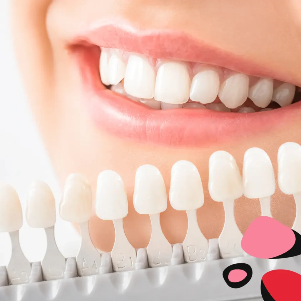 Benefits of Professional Teeth Whitening with a woman smiling against a teeth whitening chart