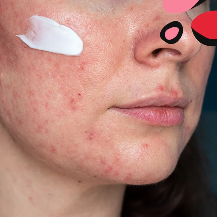 What Causes Rosacea? Everything You Need To Know
